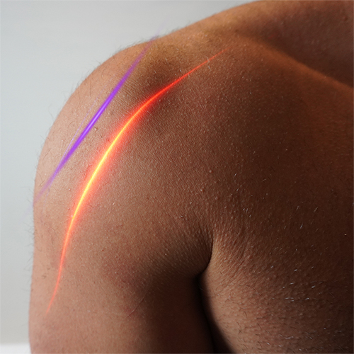 Laser treatment on shoulder